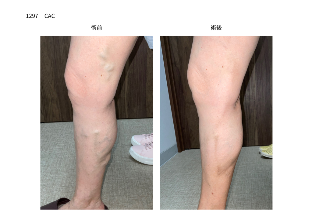 下肢静脈瘤の手術　症例写真の紹介